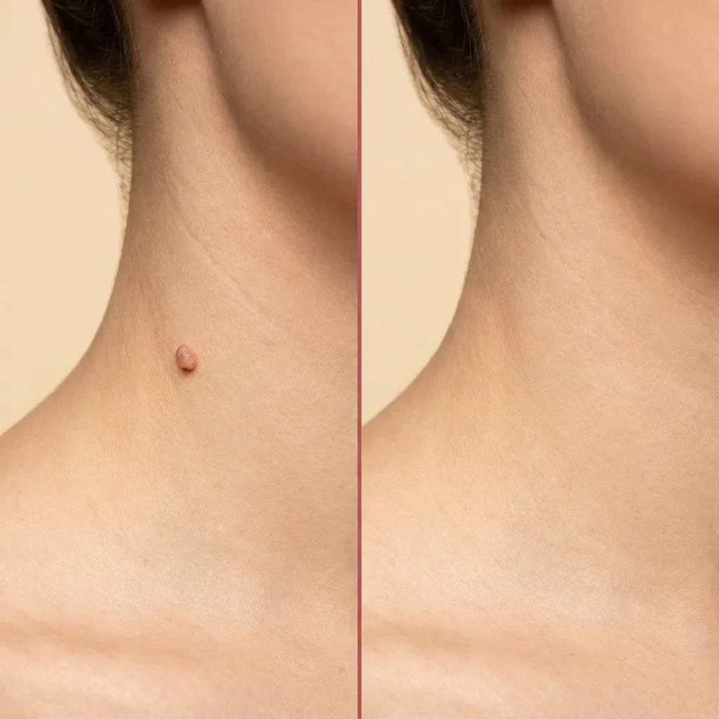 BelBexa™️ ClearTag Microneedle Skin Tag Patch