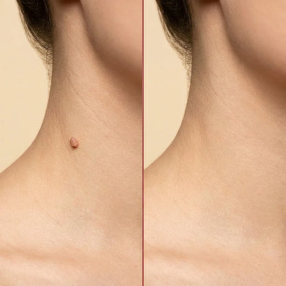 BelBexa™️ ClearTag Microneedle Skin Tag Patch