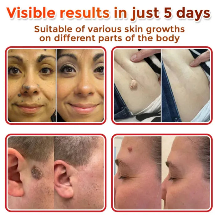 BelBexa™️ ClearTag Microneedle Skin Tag Patch